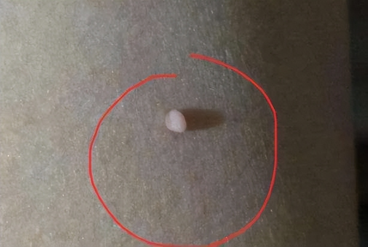 脖子上透明小肉粒可以揪下来,脖子上的小肉粒可以揪下来吗