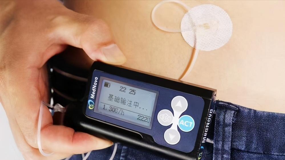 science子刊投稿,糖尿病胰岛移植最新进展