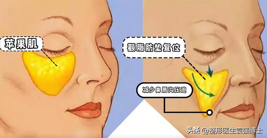 治法令纹有什么妙招,有法令纹做什么效果比较好