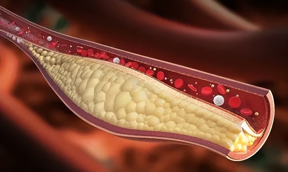 红酒软化血管靠谱吗,软化血管吃哪种鱼油