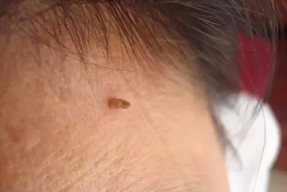 脖子上长小肉粒说明身体出了问题,脖子上的小肉粒说明身体有病