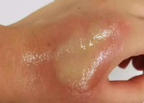 夏天时节，农村的“毛毛虫”真惹不起，被蜇后解药就在它身上