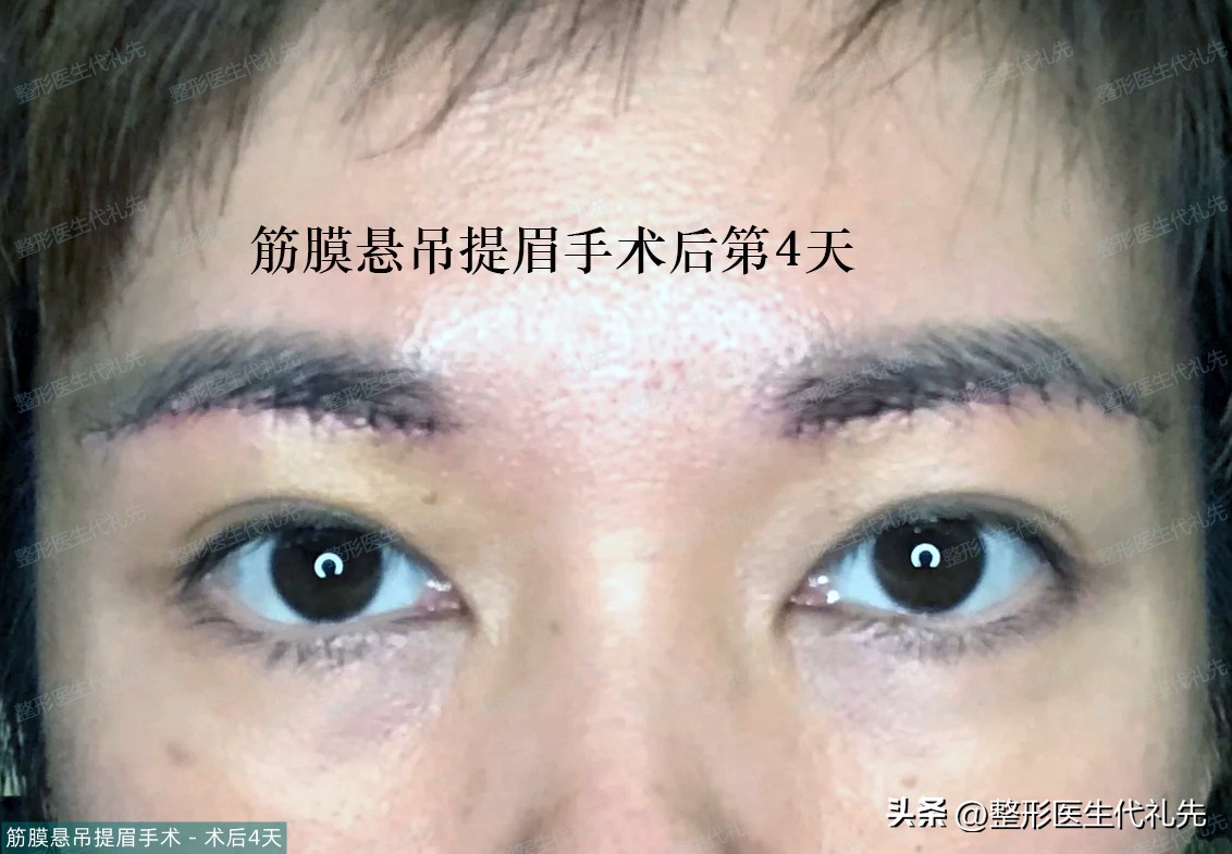 45岁女性做提眉手术多久能恢复,40岁做提眉手术的视频