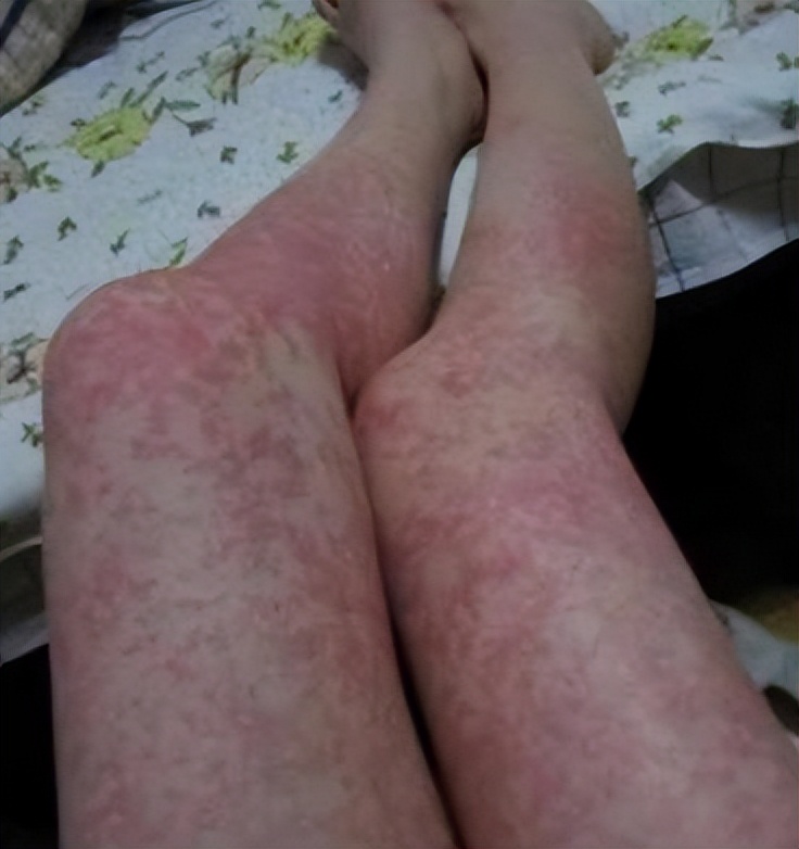 清肾丸治疗紫癜,紫癜针灸治疗