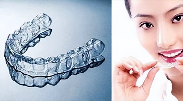 关于牙齿正畸矫正的过程,牙齿矫正的具体流程是什么