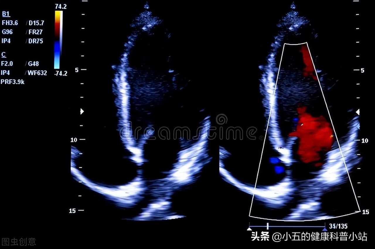 慢性心衰能长期服用螺内酯吗,心衰患者螺内酯的用法