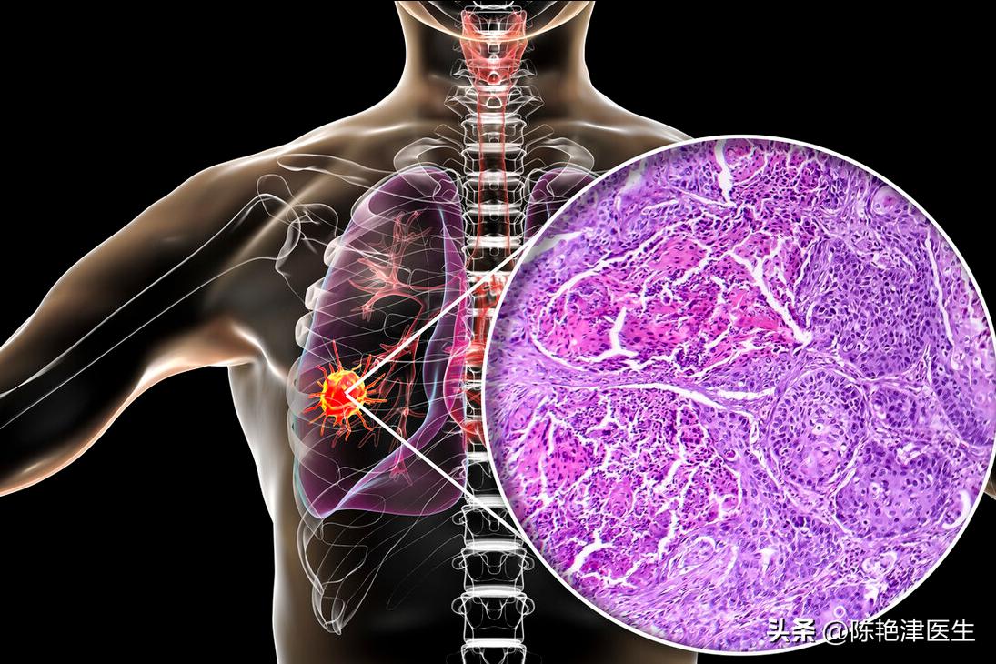 赵忠祥鳞状细胞癌早期症状,赵忠祥鳞状细胞癌有什么症状
