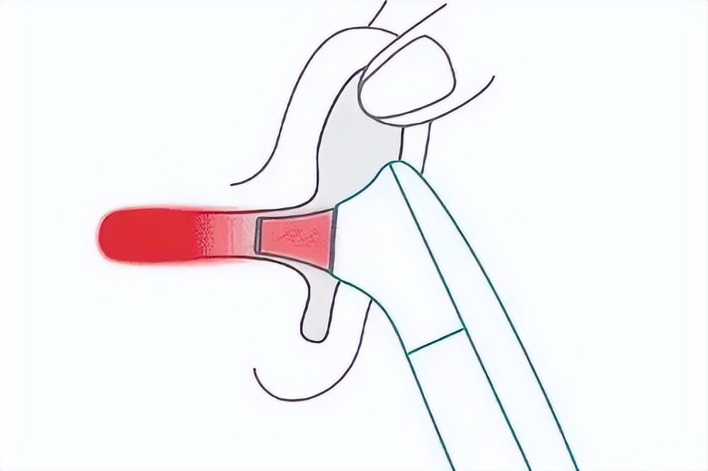 水银温度计测量37.5是不是发烧,水银体温计腋下多少度算发烧