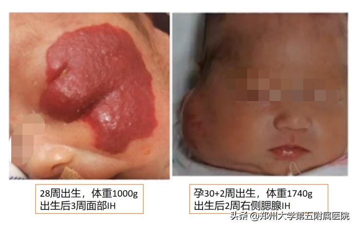 科普血管瘤有哪些治疗方法,海绵状血管瘤如何预防出血