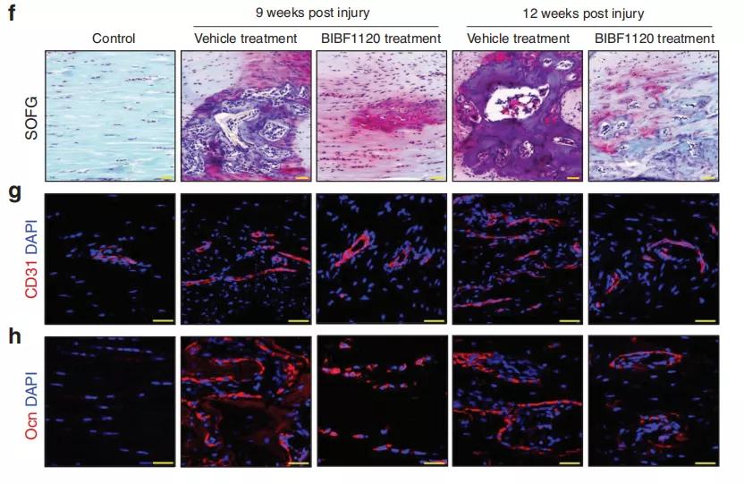 异位骨化的研究进展,肌萎缩侧索硬化症新药研究进展