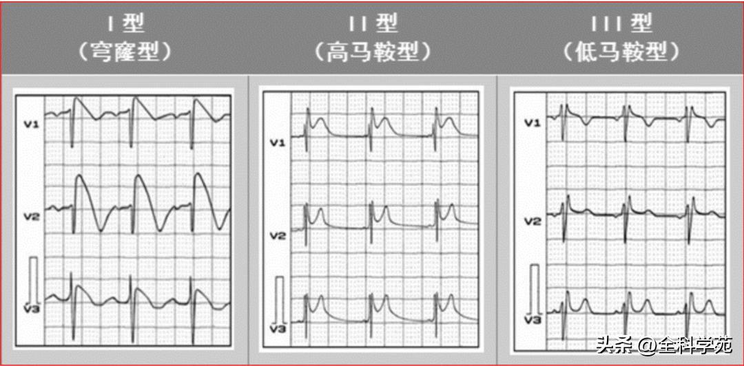 心电图qrs时限超宽严重吗,心电图qrs波形态描述