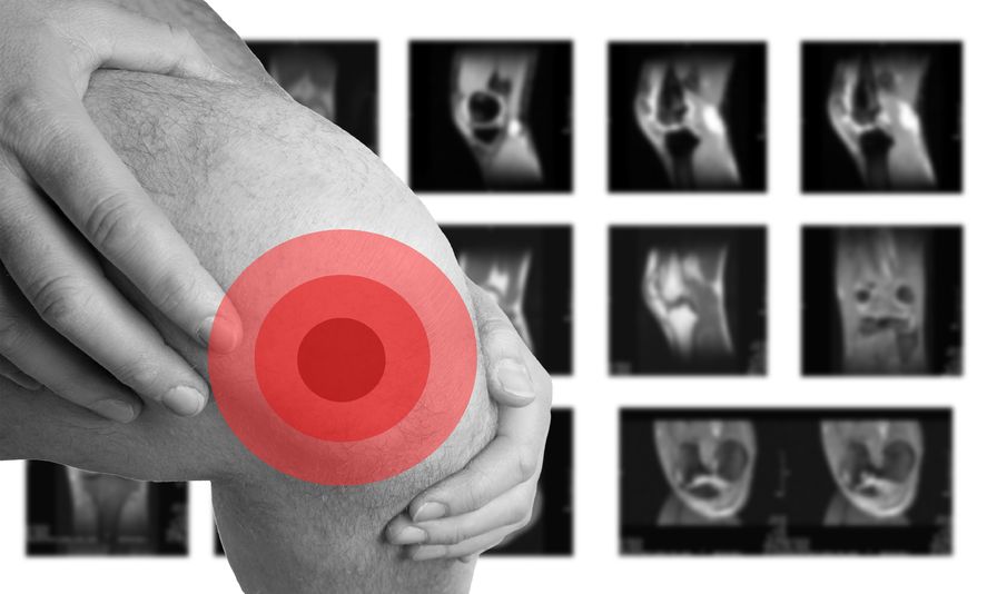 膝关节积液运动会导致积液变多吗,膝关节积液可以用拔罐清除积液吗