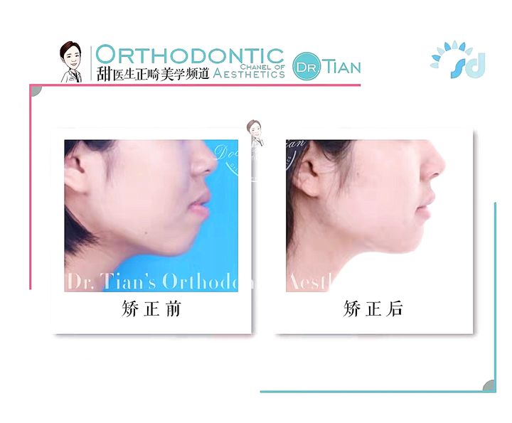 凸嘴下巴后缩拔牙改善有什么坏处,深覆合嘴凸下巴后缩矫正要拔牙吗