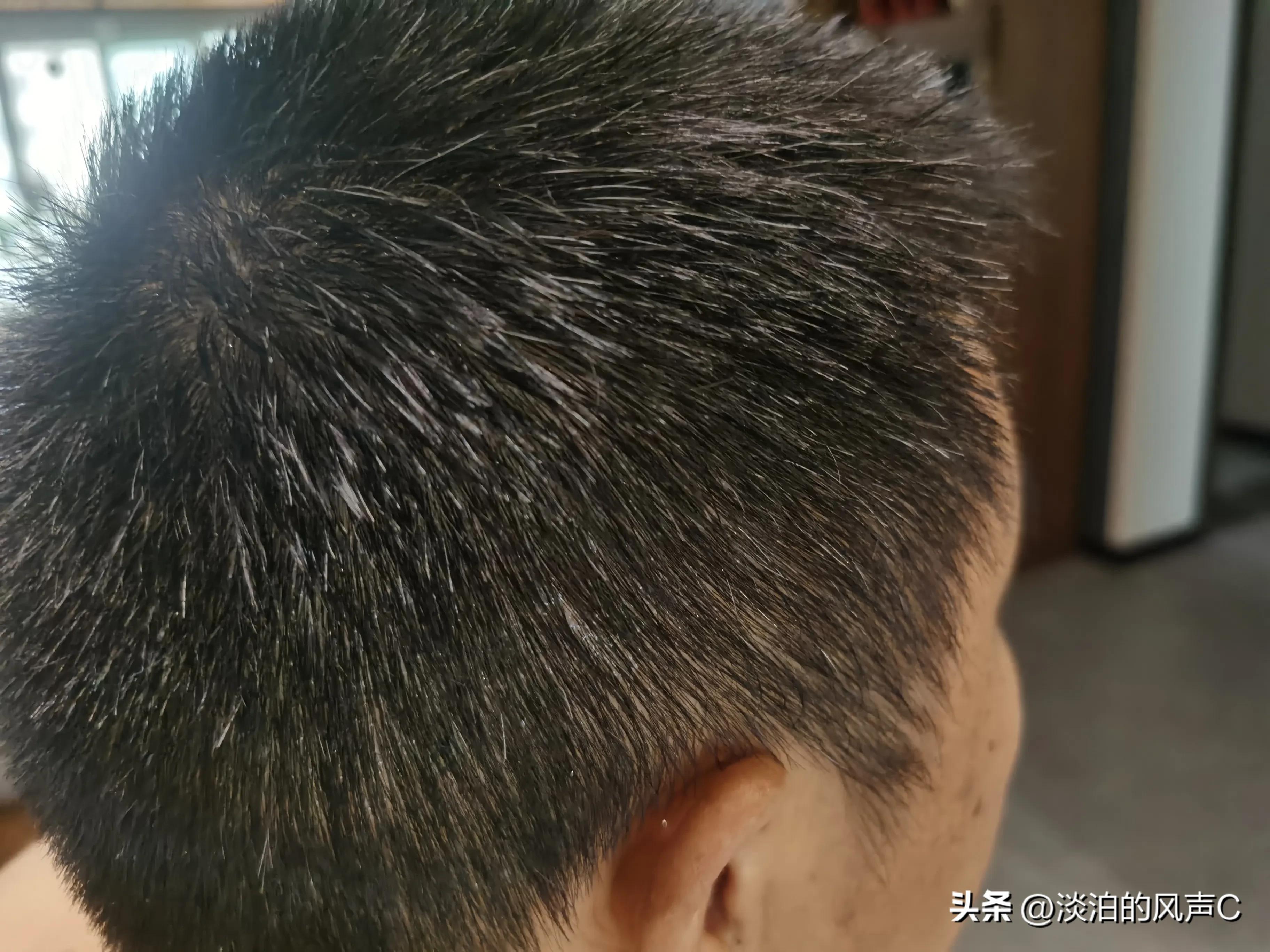 白发掉发头皮屑多吃什么改善,解决白发掉发头皮屑一切问题