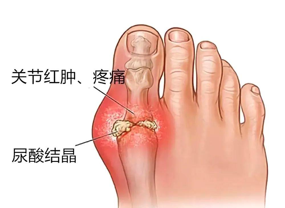 痛风好发作的部位在哪,痛风高发的人群有哪些
