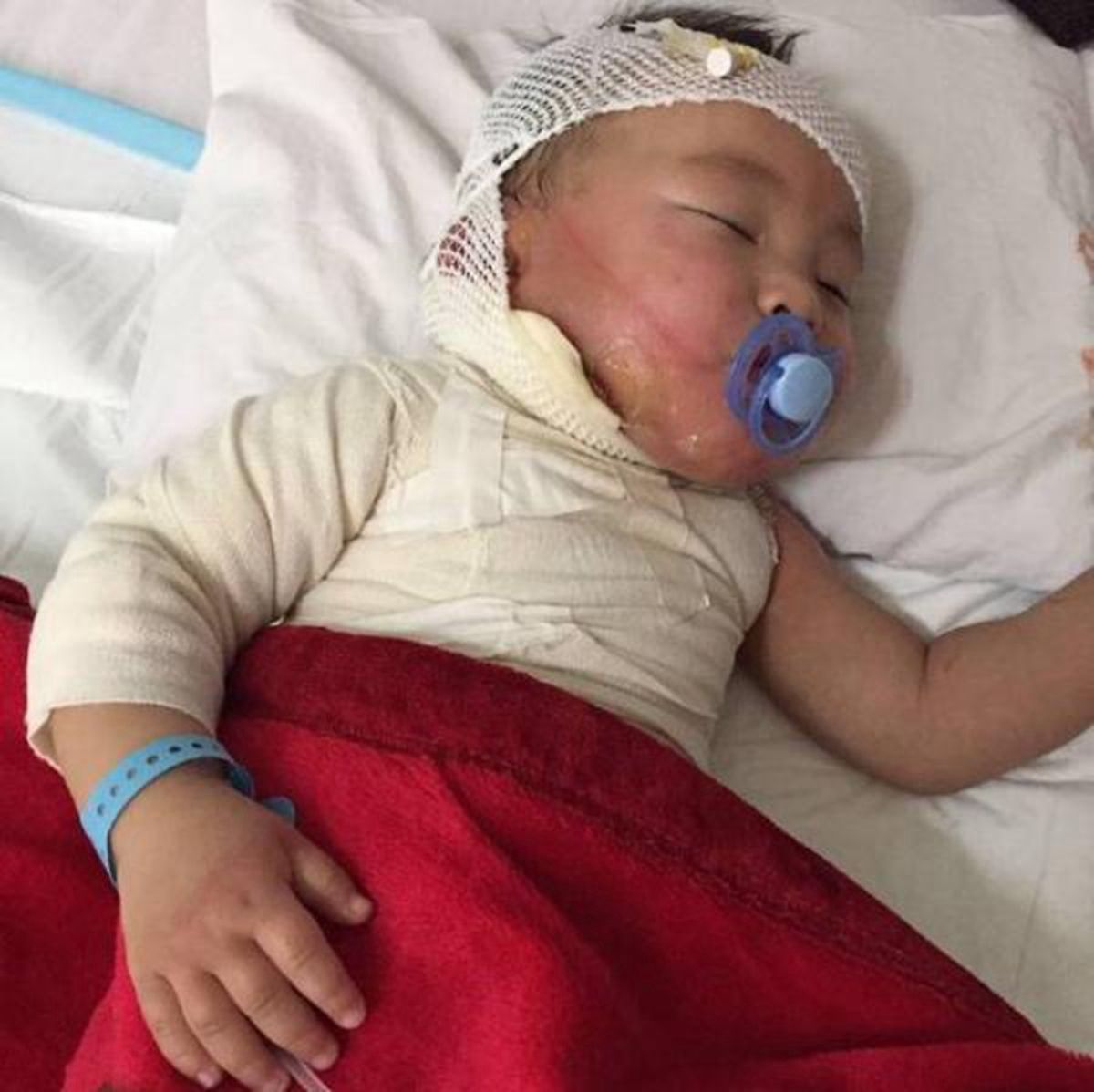 如果孩子被烫伤怎么正确处理,小孩被开水烫伤怎么处理好