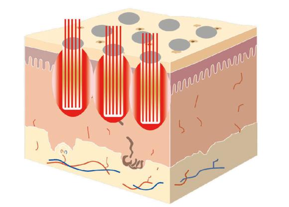 光子嫩肤哪个好,光子嫩肤哪种光波最好