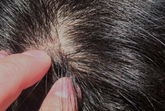 头上起疙瘩有脓包一挤出血,头上长疙瘩有脓包红肿怎么办