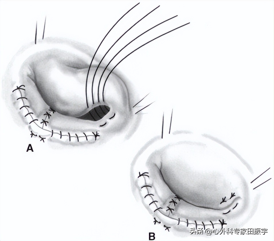 二尖瓣成形术,二尖瓣成形术后需要静养多久
