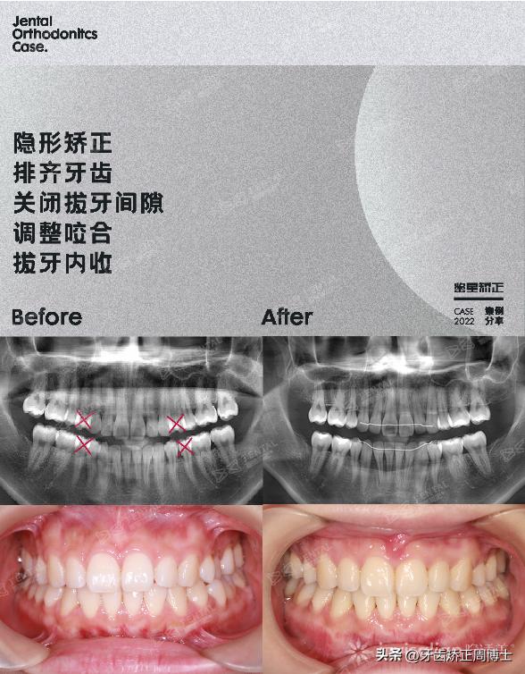 隐形矫正龅牙效果图,严重龅牙可以用隐形矫正吗