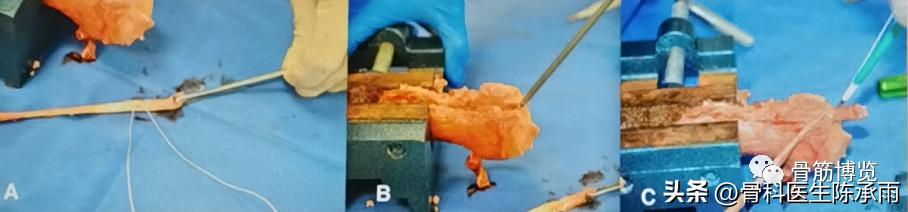 肱二头肌长头肌腱断裂超声报告,上臂肱二头肌