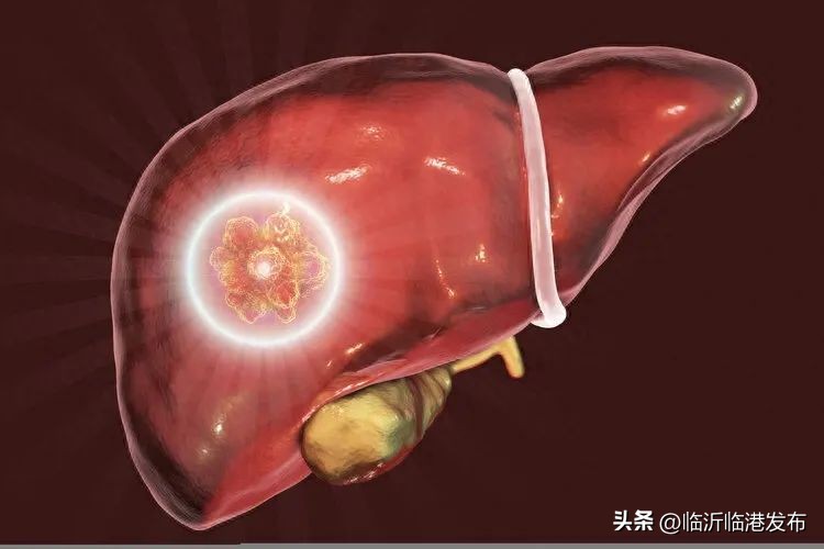 首例国产钇90治疗肝癌费用,钇90微球能根治肝癌晚期吗