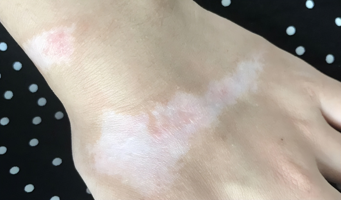 烧烫伤疤痕如何修复？烧烫伤疤痕怎么治疗？