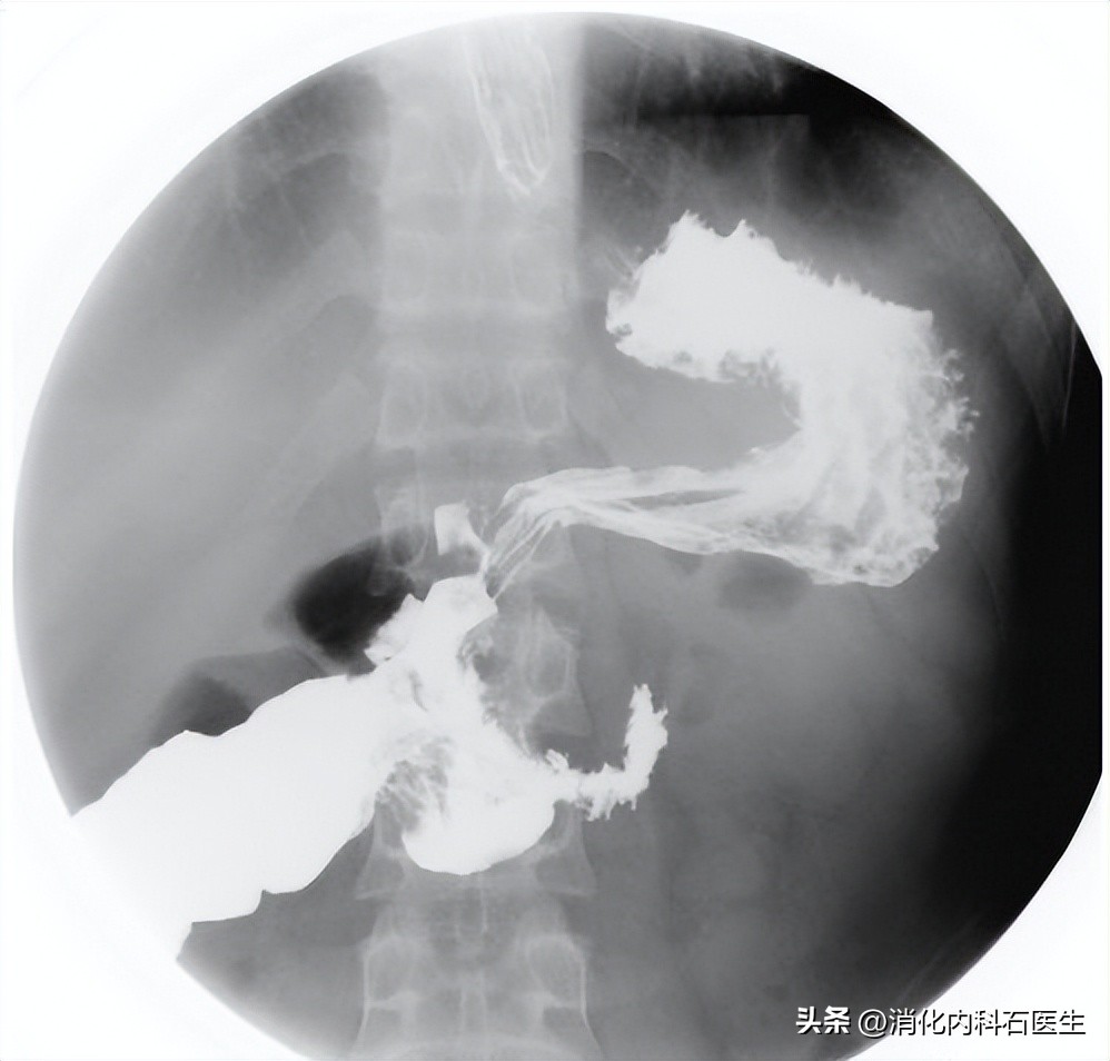 女子突发腹痛，喝可乐治疗无效，医生无奈剖腹：血管被栓了