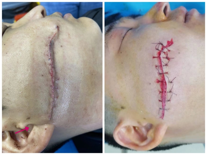 点阵激光对去除疤痕效果明显吗,点阵激光治疗疤痕能完全修复吗