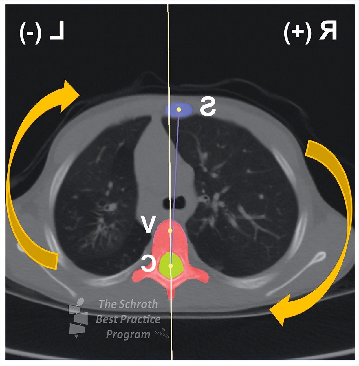 胸椎稍向右侧侧凸怎么矫正,儿童胸椎向右侧凸是什么意思