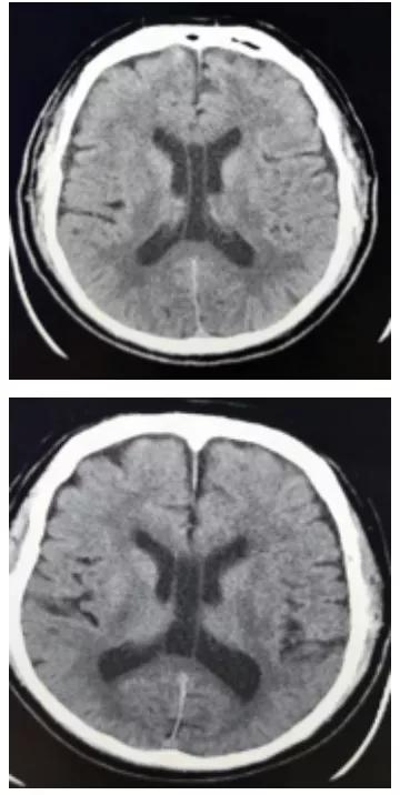 侧脑室就是透明隔腔吗,第五脑室是透明隔吗
