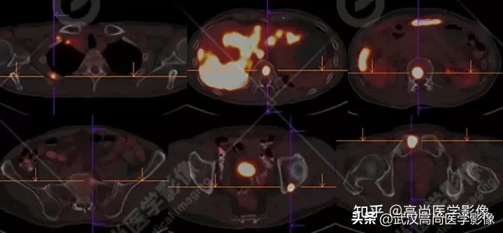 10毫米的肺结节恶性死亡率有多大,1厘米多的肺结节良性可能性多大