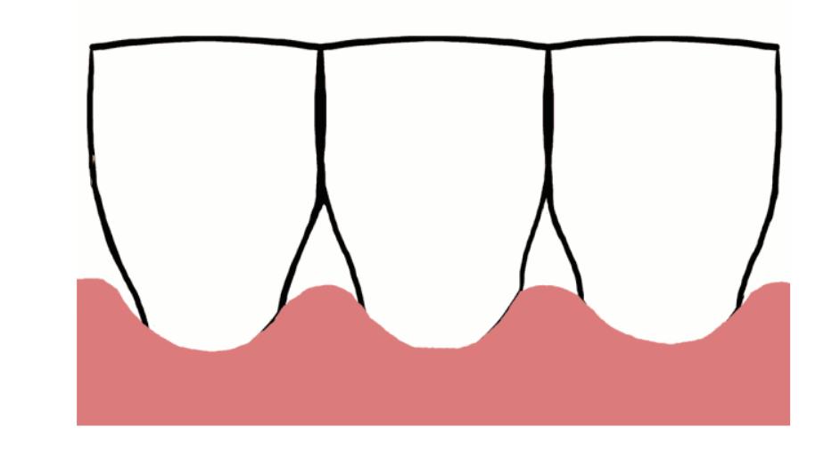 中年人正畸后的后遗症,正畸都会有什么后遗症