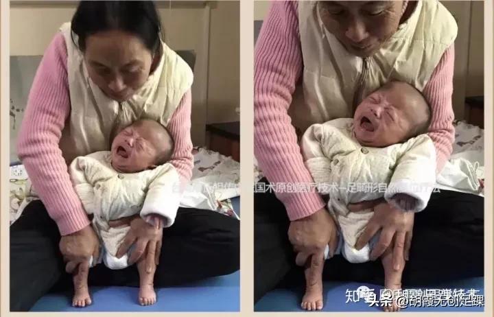 孩子足内翻跟腱术后怎样恢复,儿童偏瘫足内翻自我矫正训练