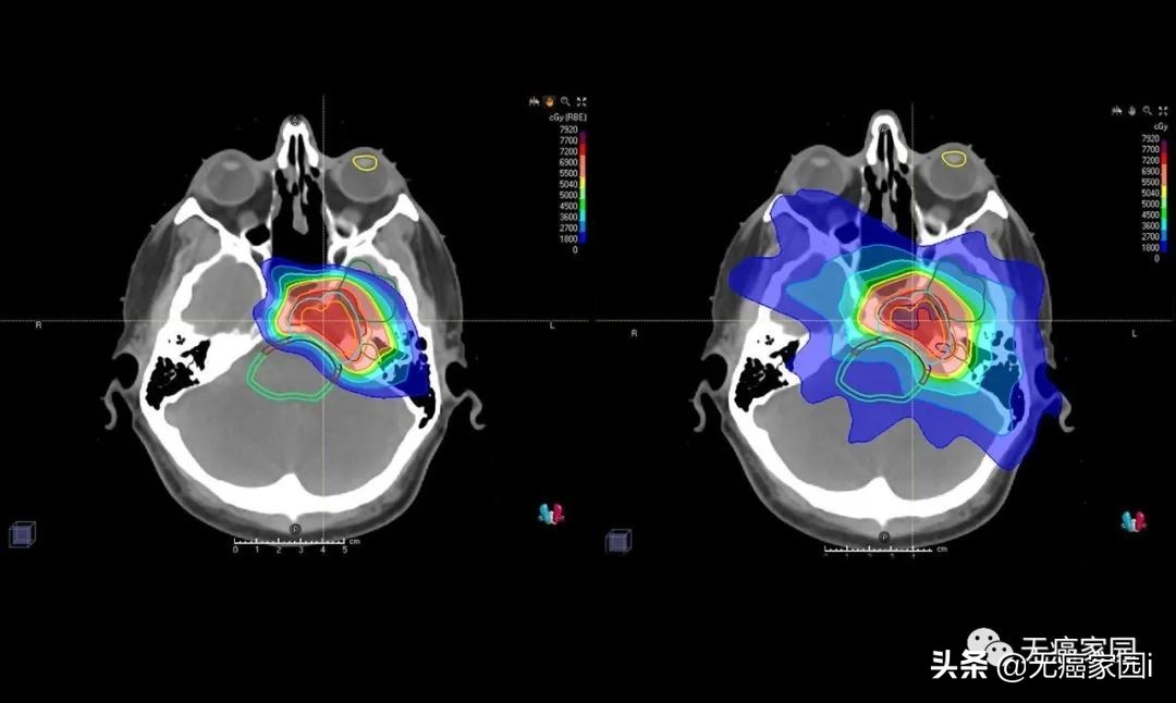 脑瘤、肺癌及儿童肿瘤等不妨考虑质子治疗,疗效和生存质量双保障