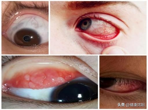 了解过敏性结膜炎的症状和治疗,饱受过敏性结膜炎的困扰
