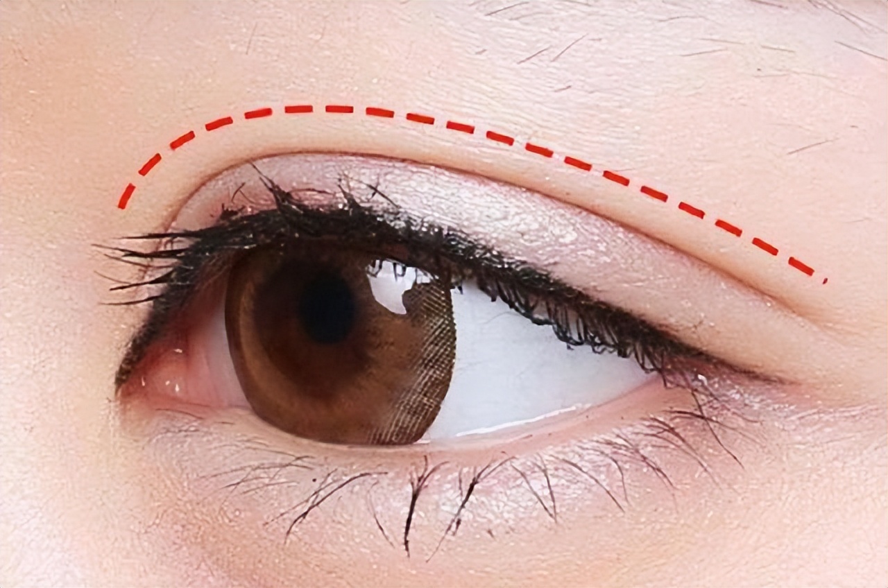 做双眼皮要注意医院的哪些套路,想做双眼皮又怕做毁了牢记这三点