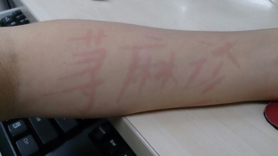 荨麻疹痒痒怎么回事,麻疹痒痒怎么办