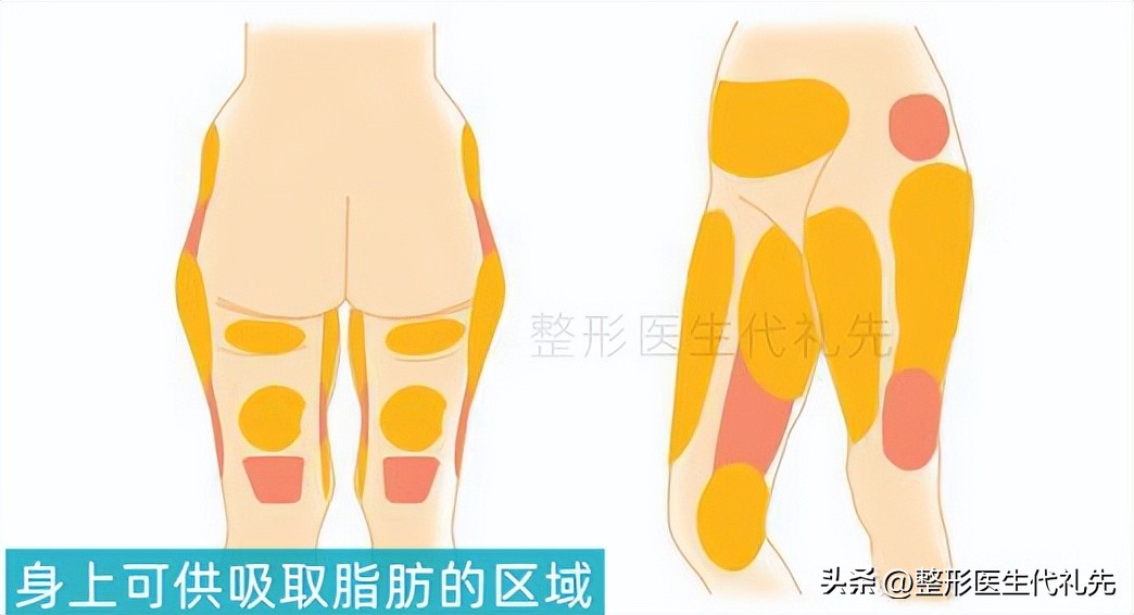 面部脂肪填充一般要多少脂肪量,脂肪填充面部有哪些脂肪可以做