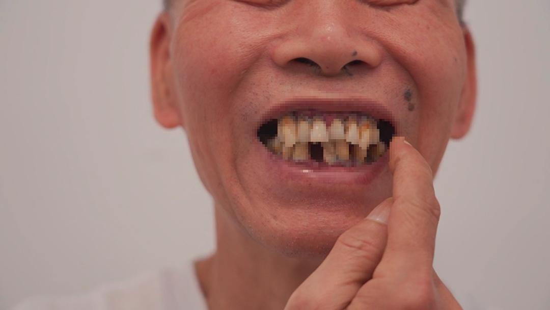 种牙前为什么要做牙冠,种牙前为什么要清理肉芽