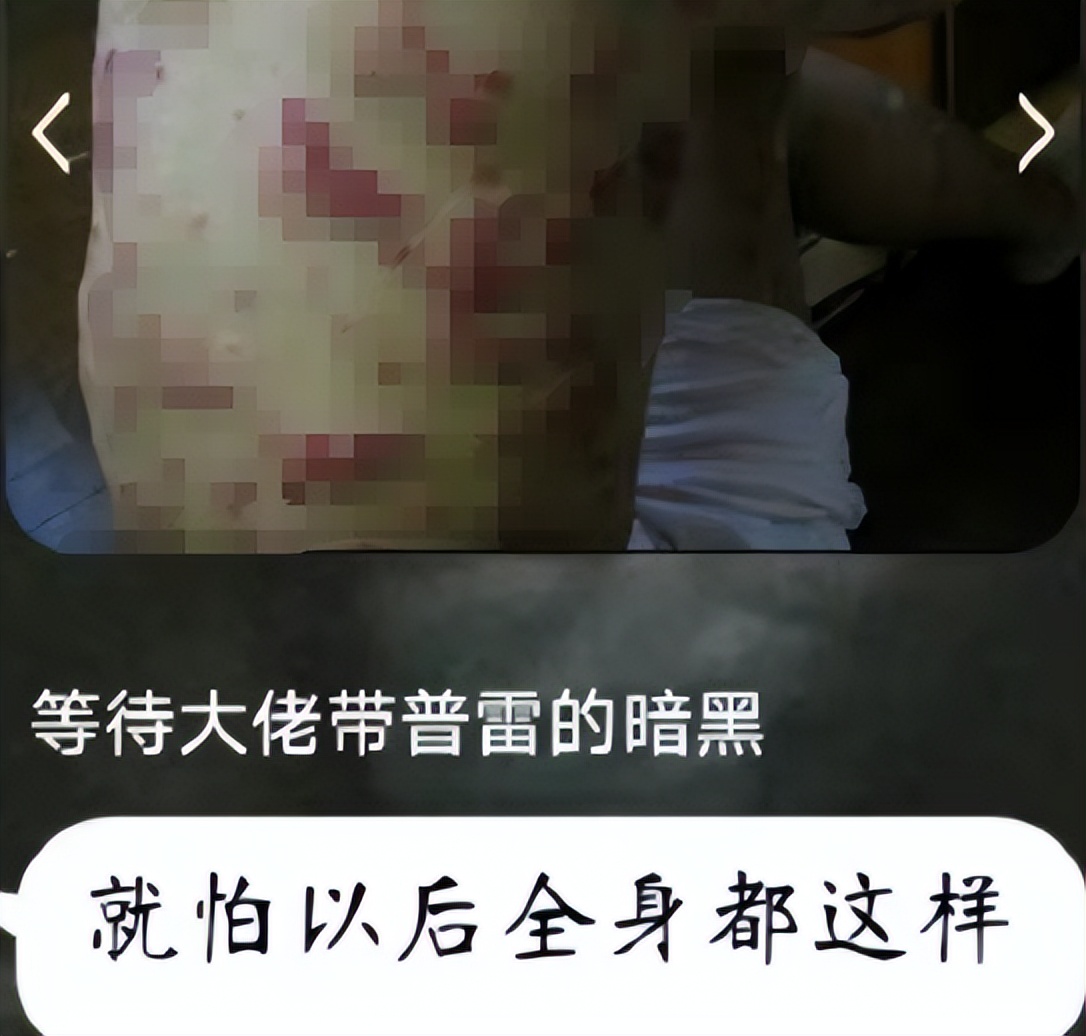 聊天记录曝光恶心一幕:老公说工作太累了长湿疹,其实是梅毒