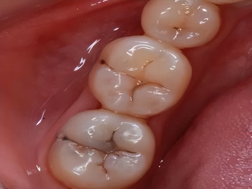 早期龋齿和中期龋齿的区别,科普口腔龋齿图片