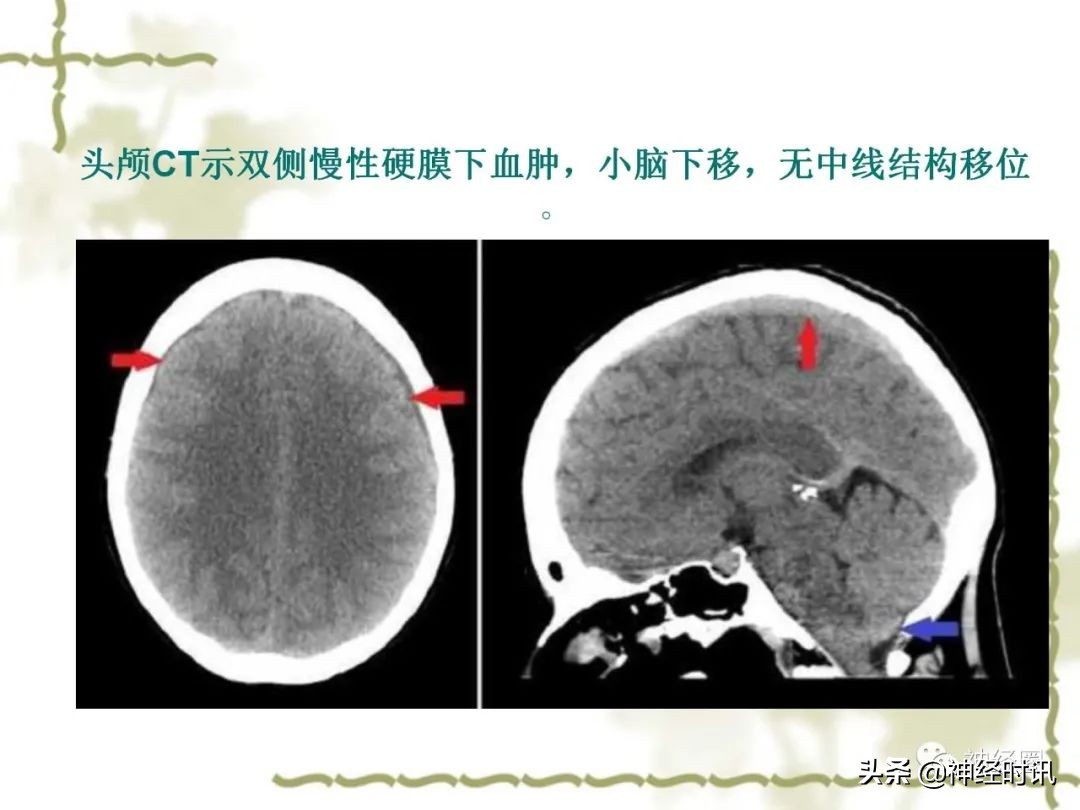 头痛从前额到头顶,头痛从左脑到右脑