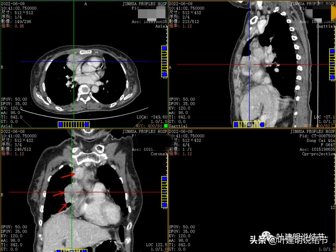 这位老乡，乏力来查，查出这么大个的纵隔肿瘤！会是什么呢？