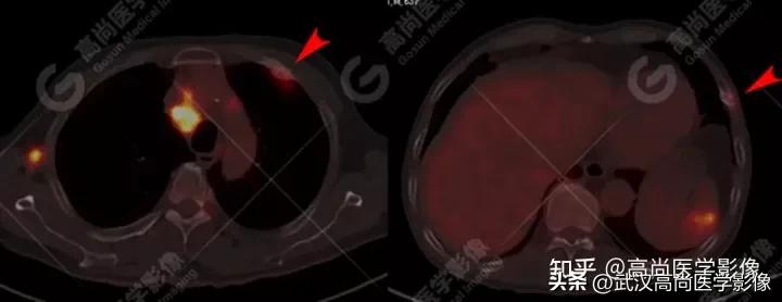 10毫米的肺结节恶性死亡率有多大,1厘米多的肺结节良性可能性多大