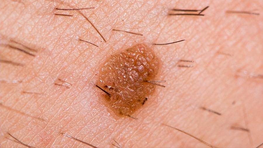 头皮上长红疙瘩脓包涂什么药膏,头皮上长红疙瘩脓包用什么药