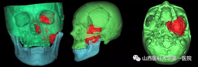 山西医科大学第一医院手术案例,山西医科大第一医院外科