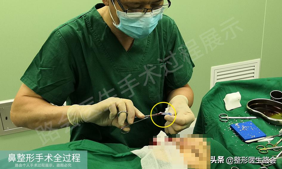 隆鼻手术全过程女生,隆鼻手术到底是怎么进行的