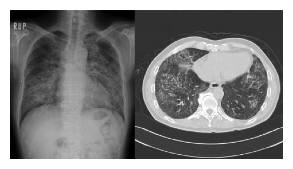 买普通的甘草片止咳可以吗,甘草片止咳化痰效果好为什么禁用