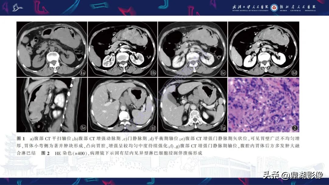 阴道肉瘤的早期症状,阴道里长肉瘤是啥症状